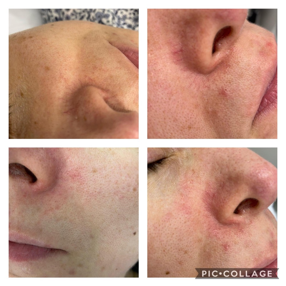 Redness treatment example collage